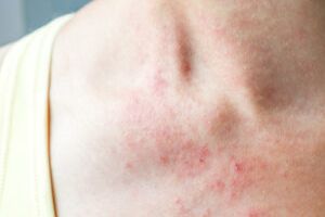 Cuáles son los beneficios y los riesgos de la fototerapia para la  dermatitis atópica?