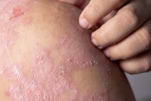 Cuáles son los beneficios y los riesgos de la fototerapia para la  dermatitis atópica?