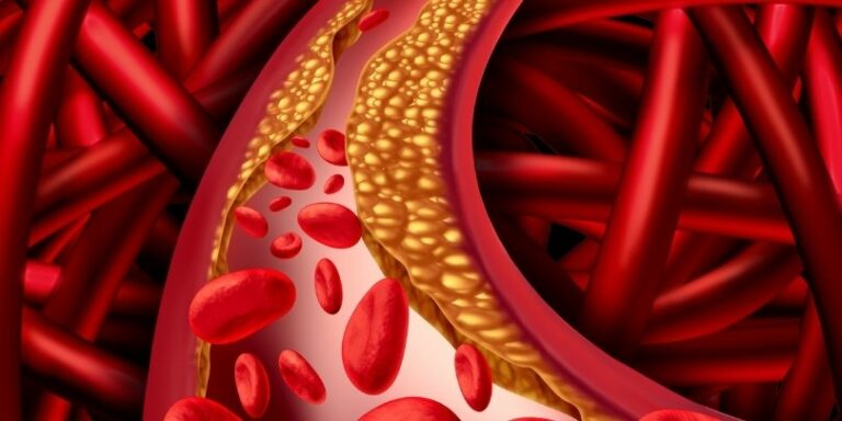 Cómo curar y prevenir la arteriosclerosis y/o aterosclerosis